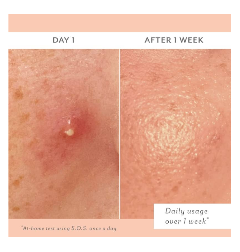 S.O.S. Totally Invisible Clarifying Liquid Patch